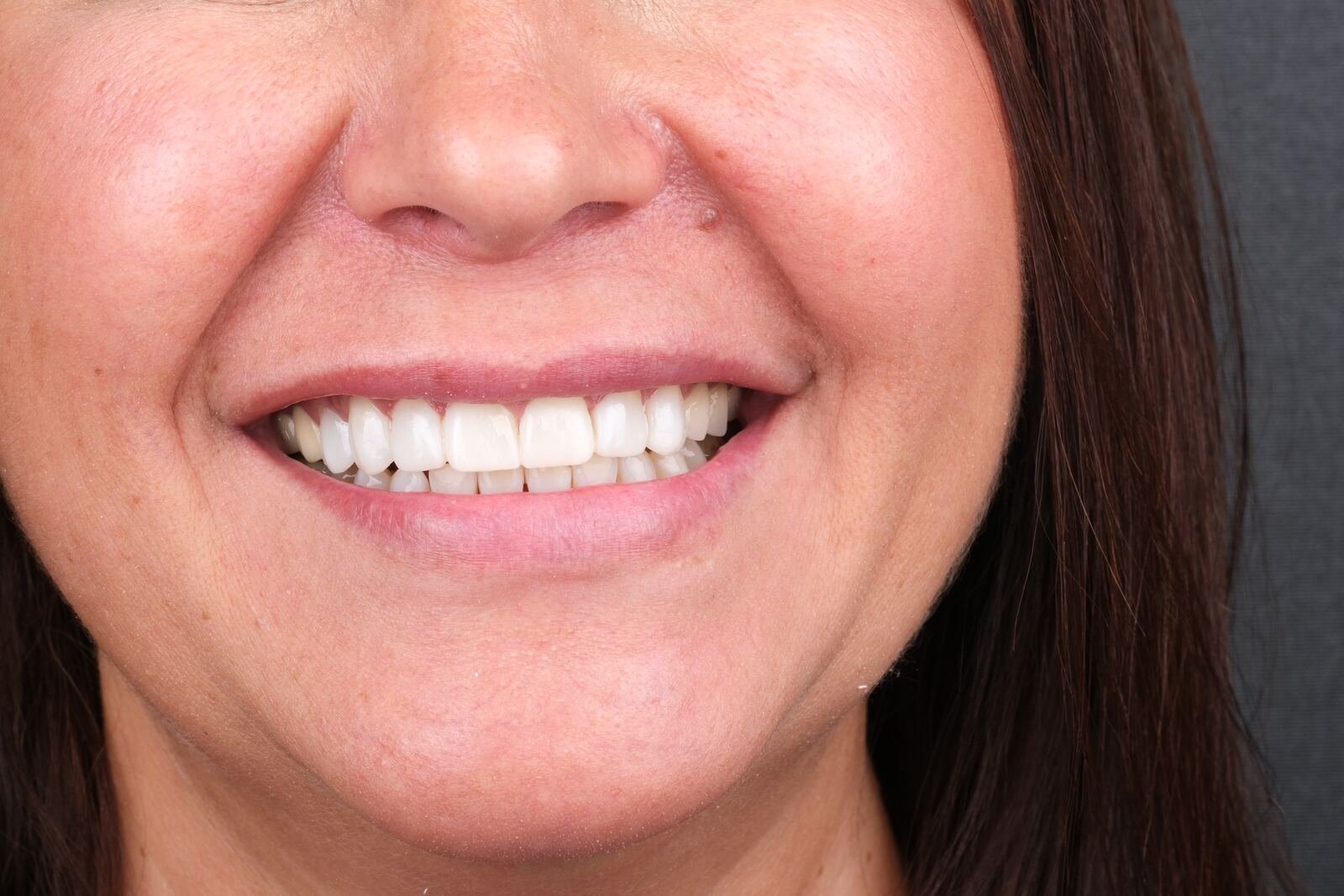 Composite bonding — after, natural shape and surface texture restored.