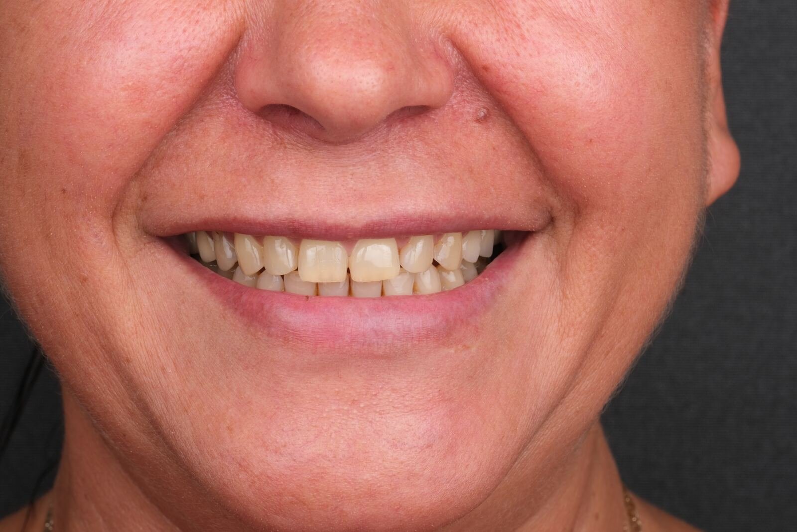 Composite bonding — before, slightly misaligned and worn front teeth.