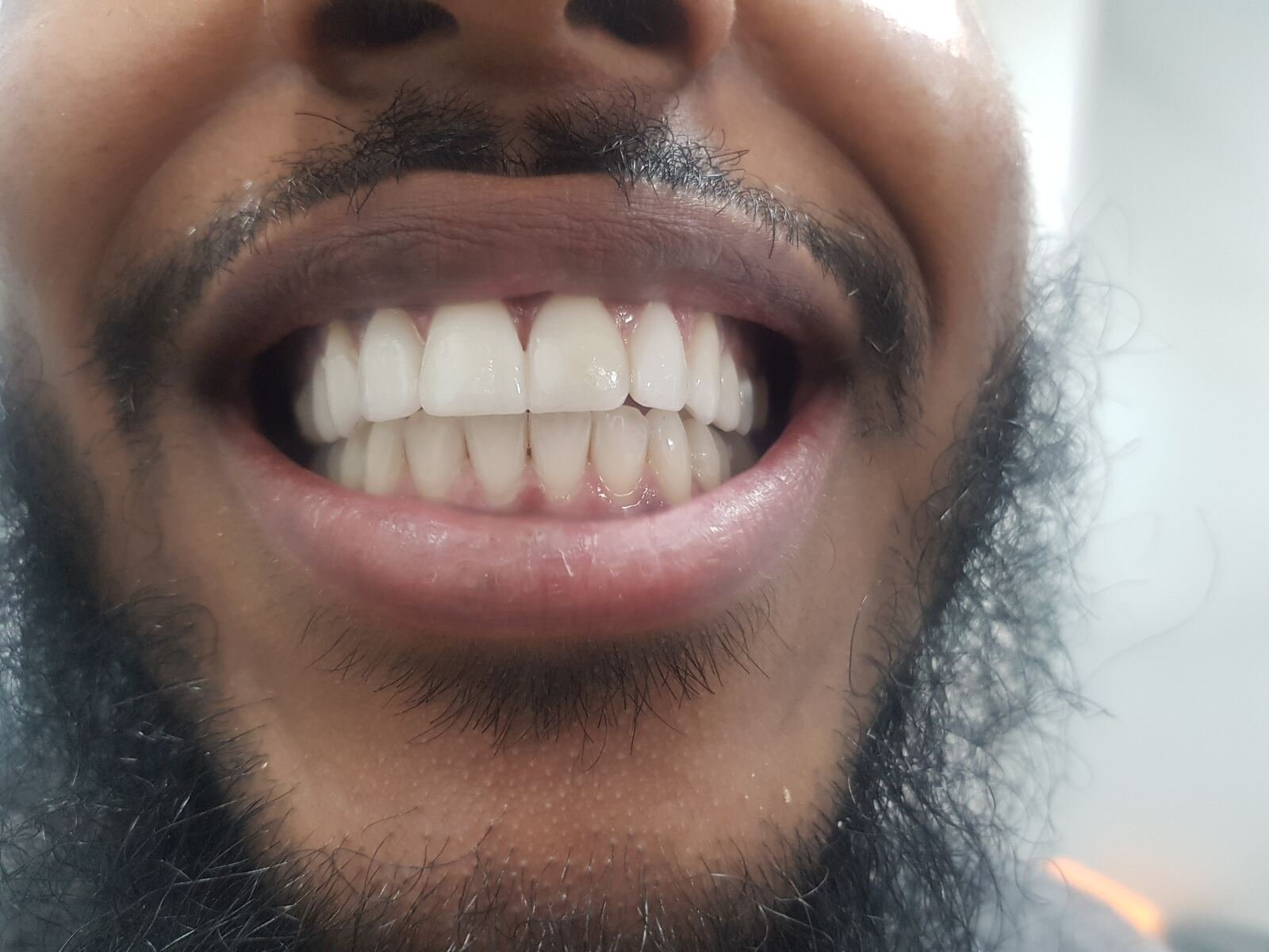 Diastema closure — after, gap closed with composite bonding.