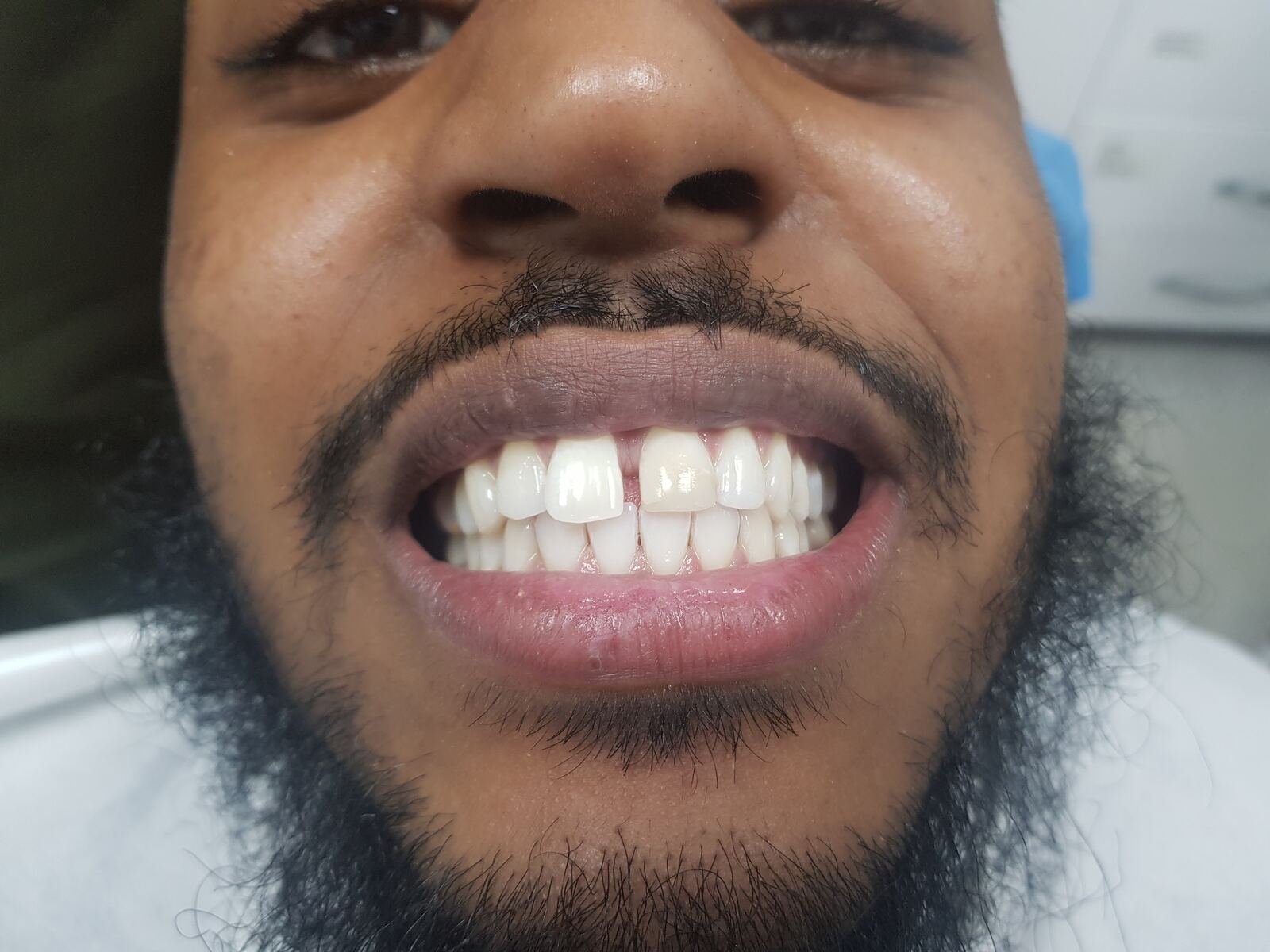 Diastema closure — before, with visible gap between central incisors.
