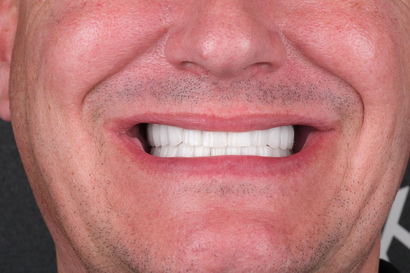 Implant case — after Straumann implant and zirconia crown placement.