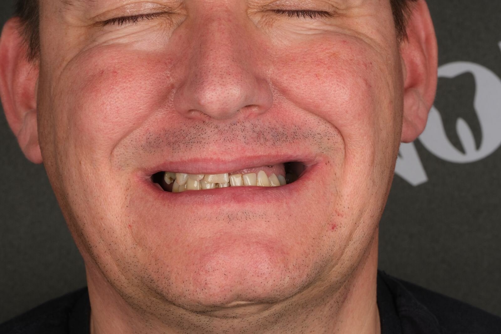 Implant case — before treatment, missing posterior teeth.