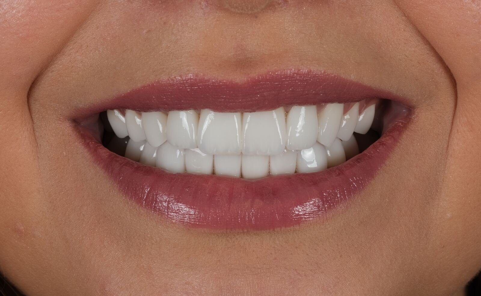 Smile makeover — after treatment with E.max veneers, natural shape and translucency restored.