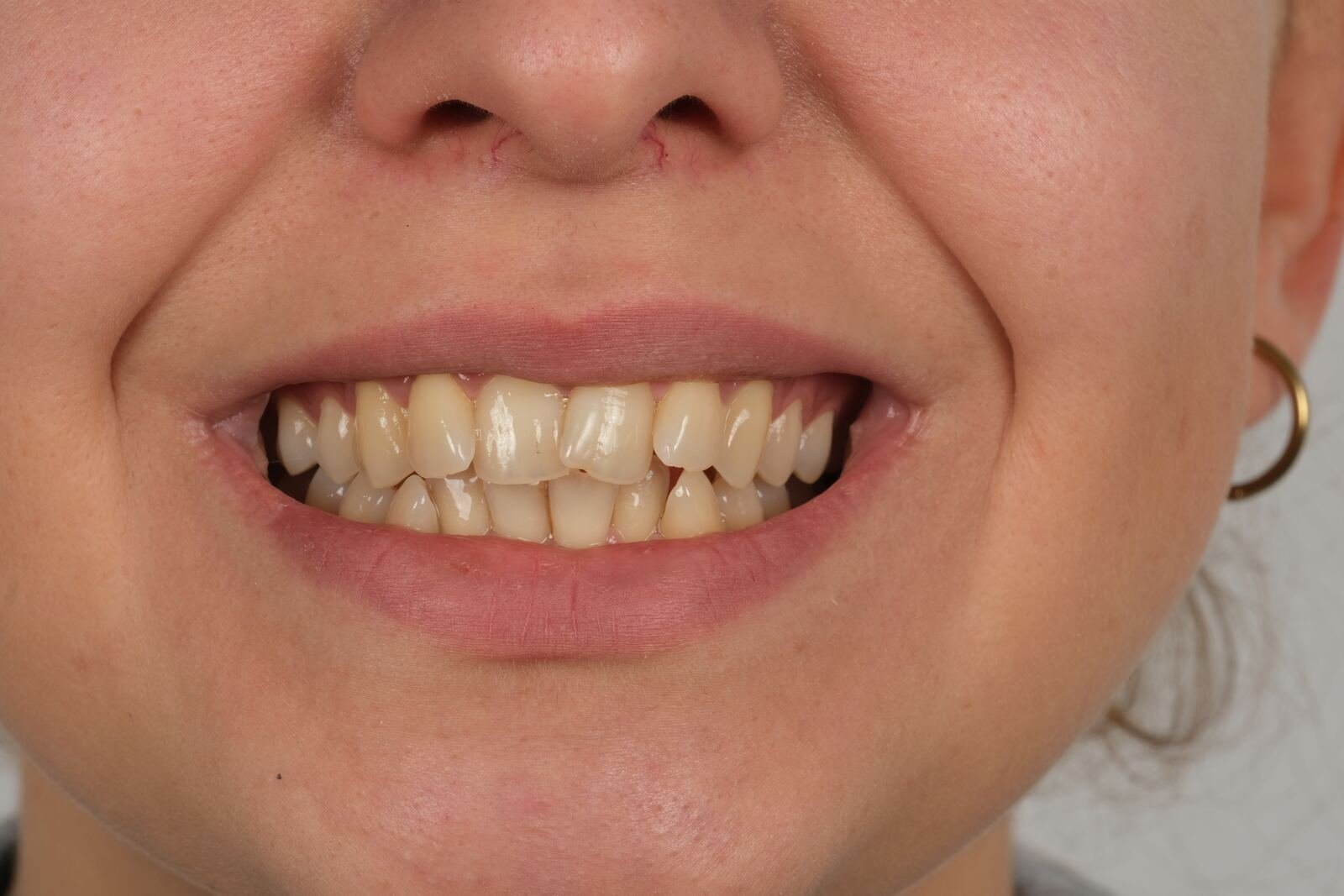 Smile makeover — before treatment, showing worn and discoloured anterior teeth.
