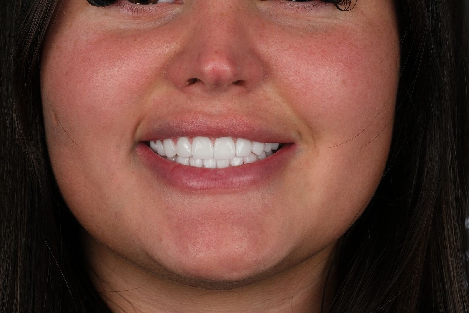 Hollywood whitening — after laser whitening protocol, multiple shades brighter.