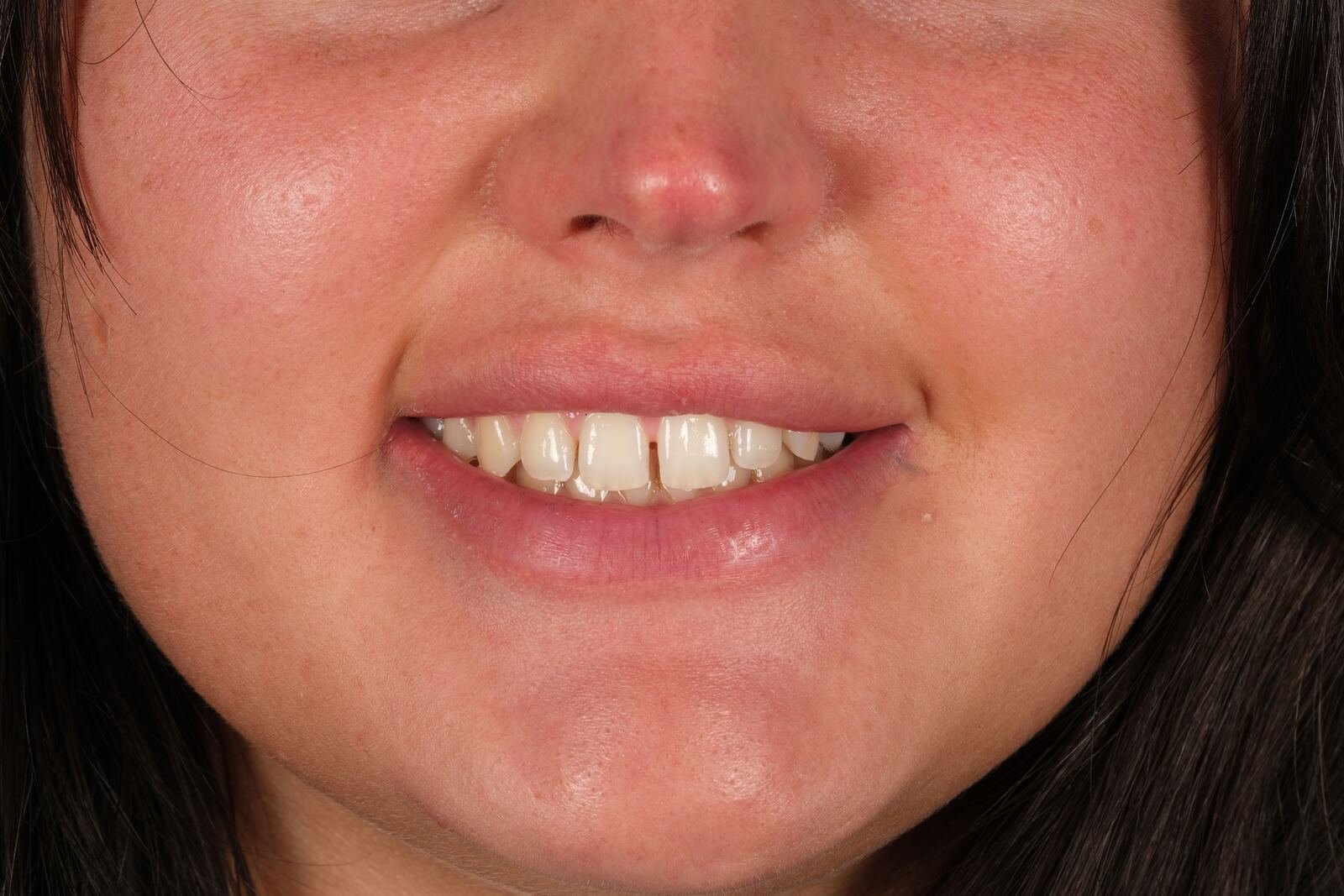 Hollywood whitening — before, with discoloration from coffee and time.